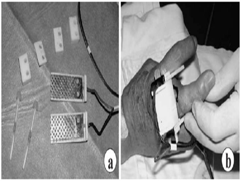 Chondrosarcoma electrode and protocol.jpg
