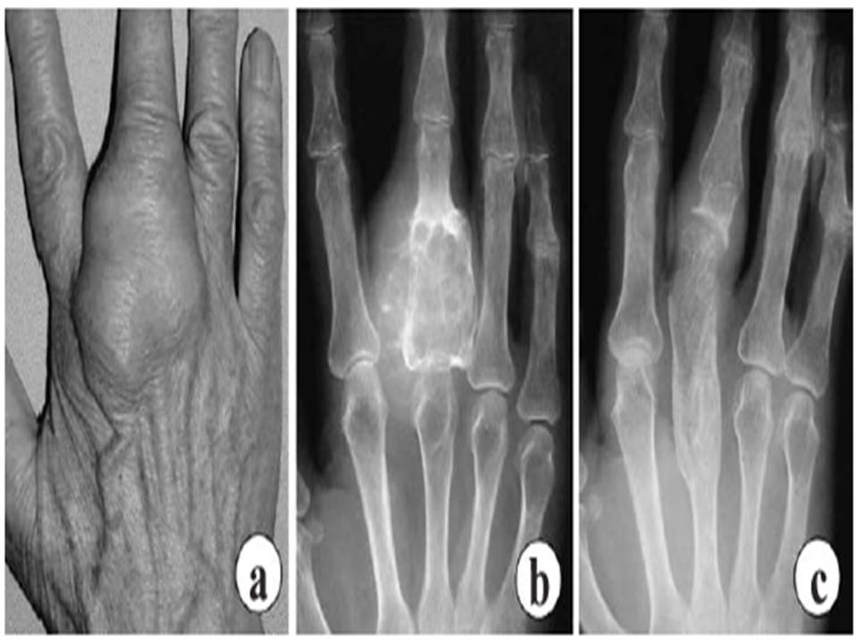 Swolen proximal phalanx of the middle finger.jpg